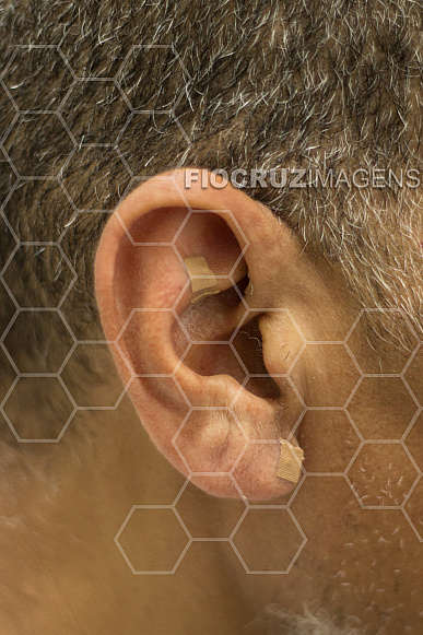 Auriculoterapia